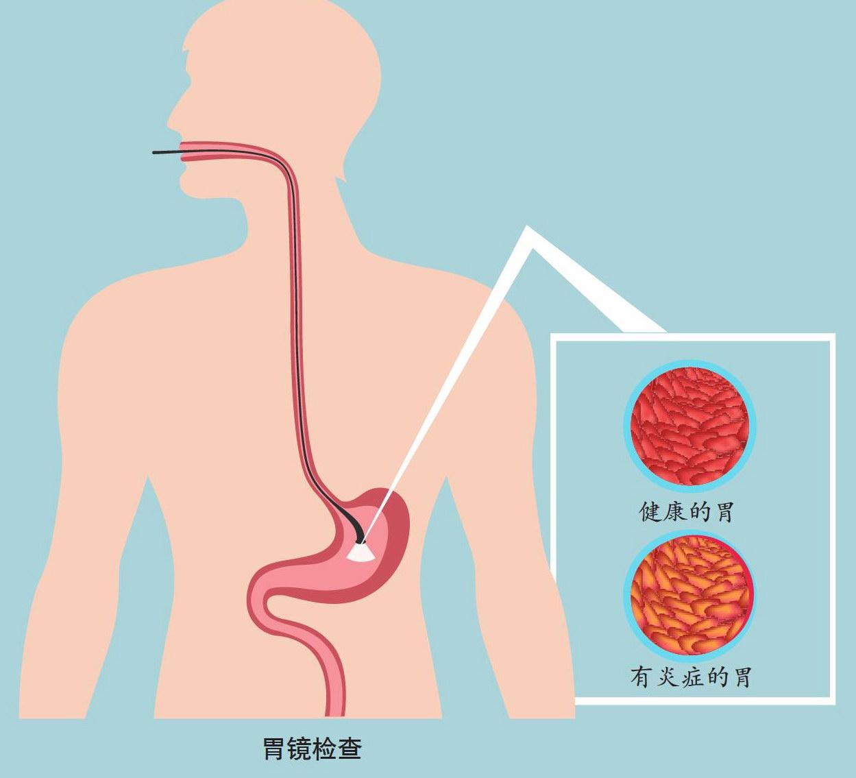 常见胃病症状及日常养护小窍门，助你养出好肠胃__中国医疗