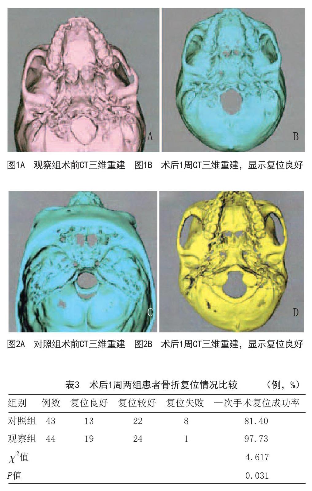 不同手术方式对颧骨复合体骨折的疗效比较