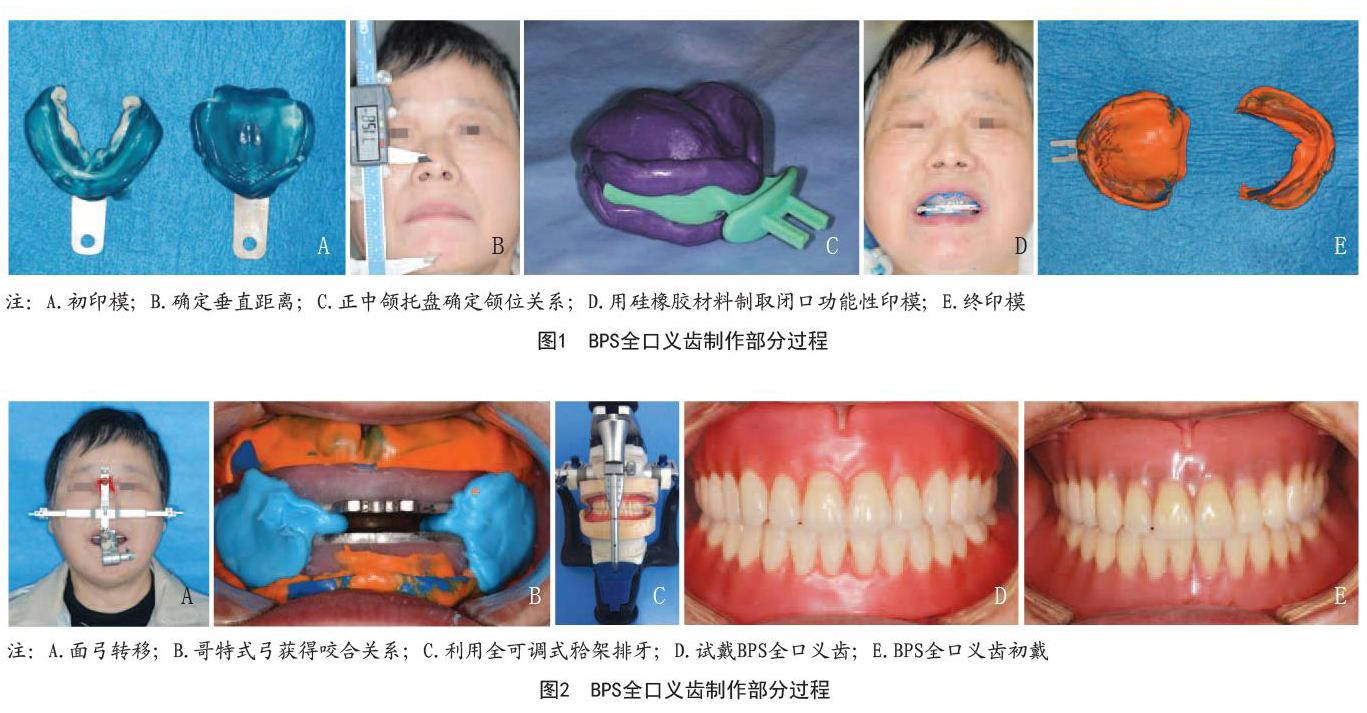 生物功能性全口义齿修复牙列缺失的临床疗效评估