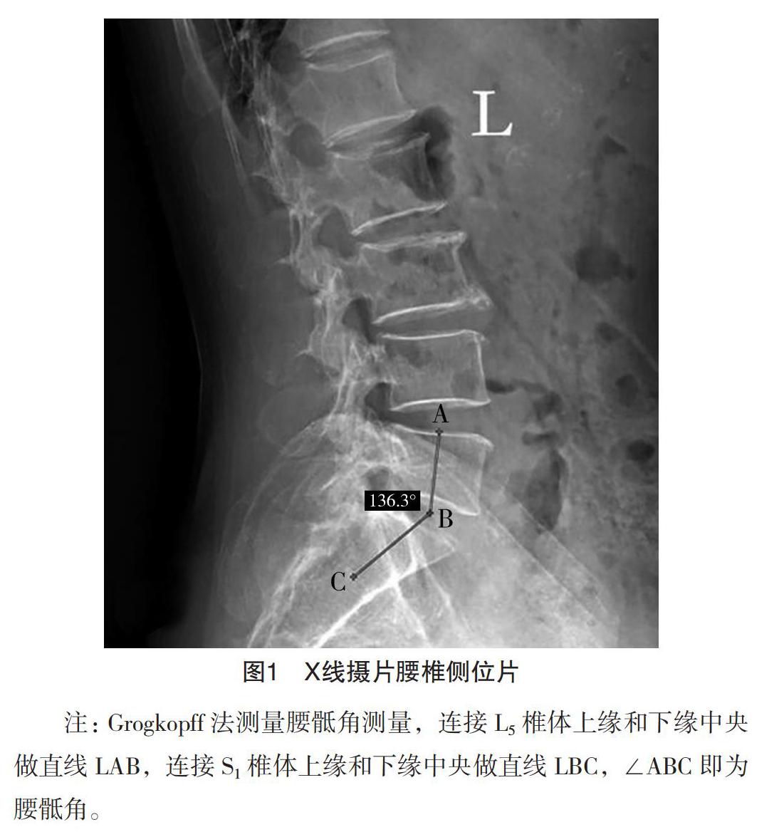 腰骶角及症状体征综合评分对l5~s1椎间盘突出患者的辅助诊断价值