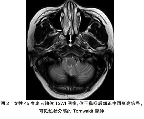 成人颅脑mri检查偶然发现的tornwaldt囊肿的影像学特点 附275例分析 参考网