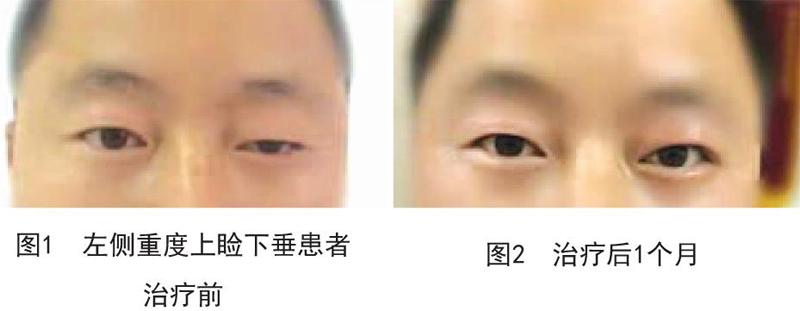 联合筋膜鞘悬吊术与额肌瓣悬吊术治疗重度上睑下垂的美容效果比较