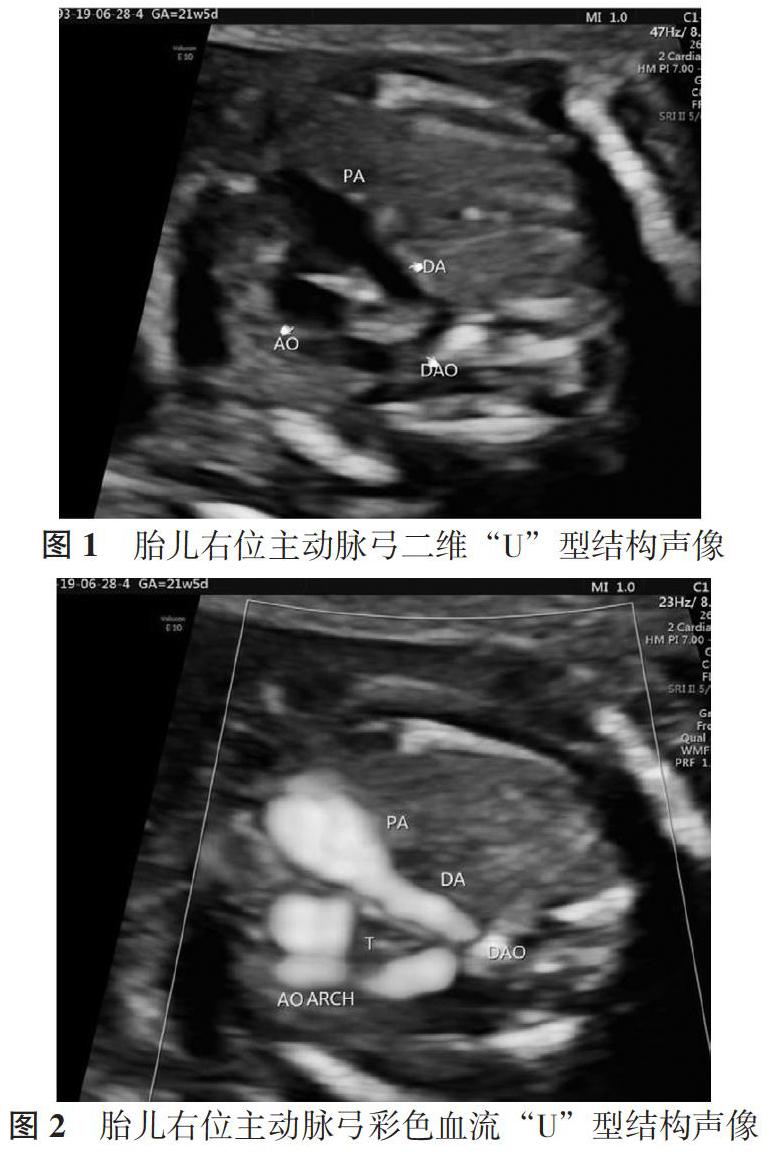 胎儿右位主动脉弓的产前超声诊断分析