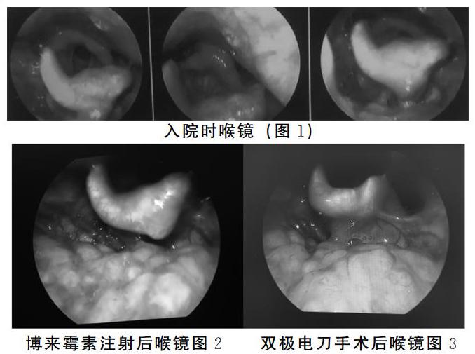 會厭血管瘤綜合治療一例