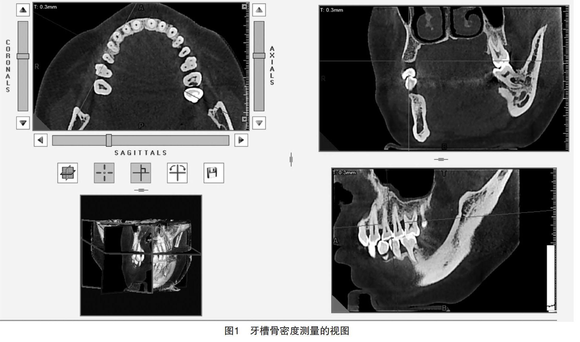 二、牙周翻瓣术的适应证及术后愈合方式-口腔临床指导-医学