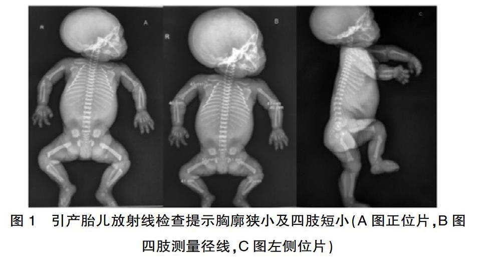 [摘要] 目的 分析胎儿软骨发育不全的超声,放射线表现及基因检测,提高