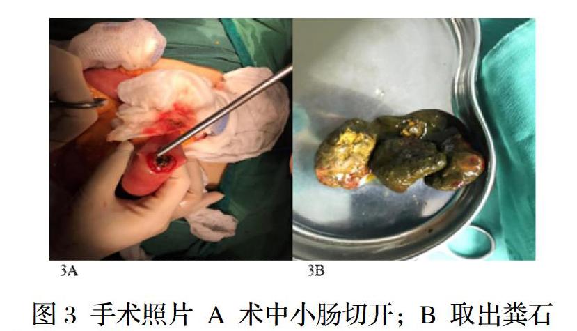 粪石性肠梗阻图片