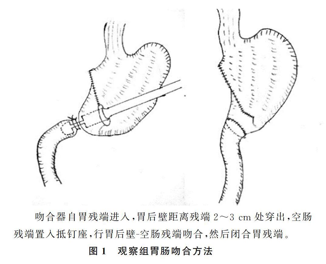 肠道吻合术图解图片