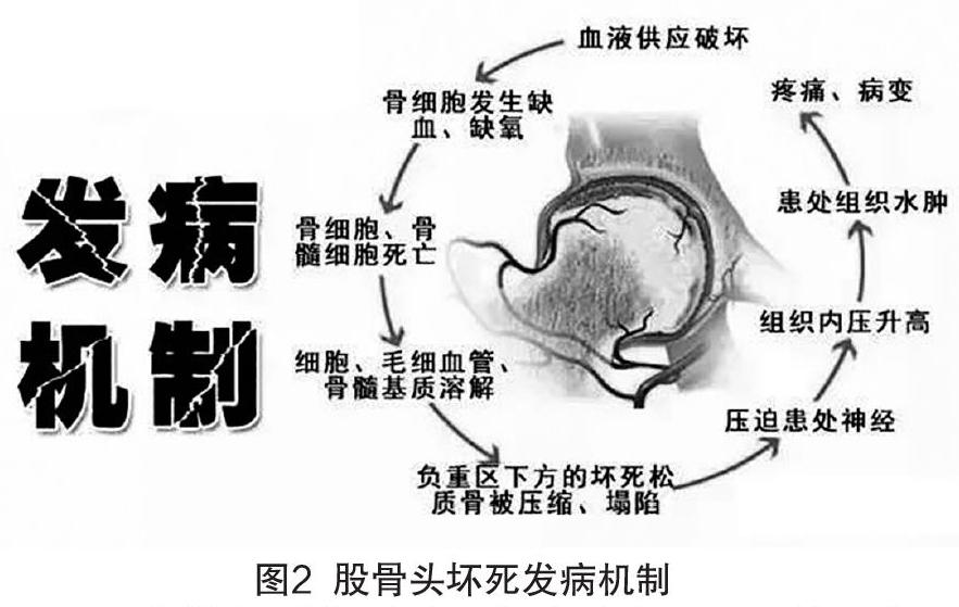 關於股骨頭壞死早期症狀及預防措施