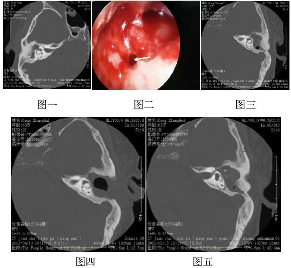 但在临床上,尤其基层仍有发生,故常令基层医生对中耳乳突手术望而止步