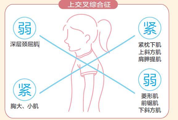 下交叉综合症图解图片