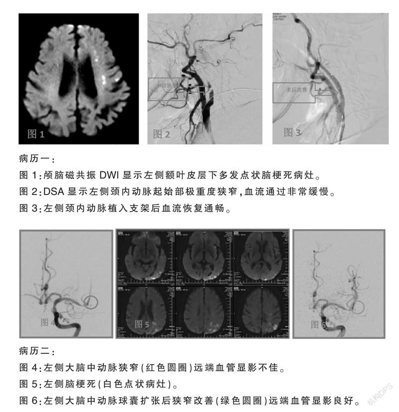 脑动脉粥样硬化及脑缺血性疾病