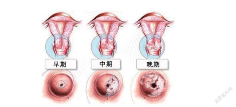 你知道怎么样早期发现宫颈癌吗